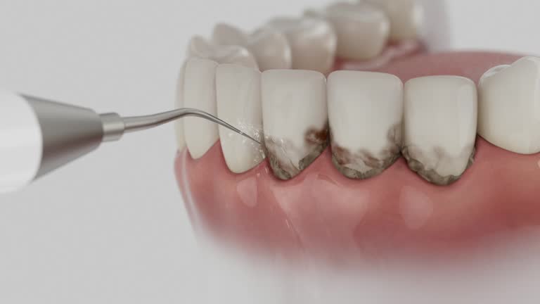 Trusted Wisdom Tooth Removal service in Cottondale, AL - Dentist Open Now